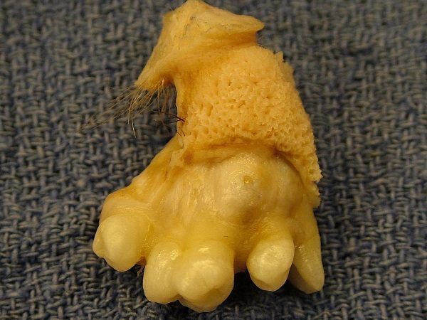 Fragment potworniaka jajnika, w którym wyrosły włosy i zęby .(zdjęcie opublikowane na licencji CCA-SA 3.0, autor: Billie Owens).