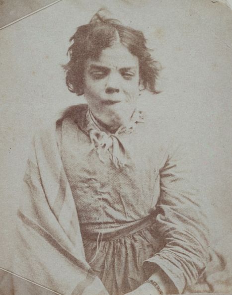 Pacjenta angielskiego zakładu dla obłąkanych na fotografii z połowy XIX wieku. W opinii doktora Mobiusa niczym nie różniła się ona od wszystkich innych kobiet - również umysłowo upośledzonych.