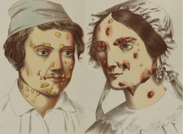 Przebieg choroby był bardzo przykry