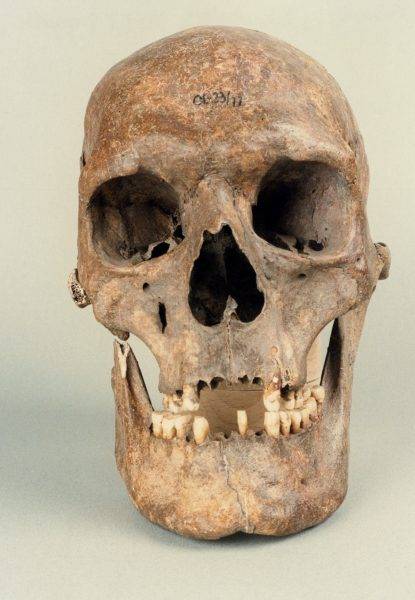 Nietypowa była także budowa czaszki, najprawdopodobniej spowodowana chorobą związaną z wysokim wzrostem. Długa, również masywna żuchwa charakteryzowała się obecnością kątów prostych.