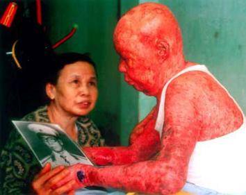 Major Tự Đức Phang był narażony na działanie skażonego dioksynami Agent Orange.