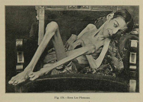W 1882 roku po licznych badaniach lekarskich w końcu zdiagnozowano u Isaaca atrofię mięśniową. Na tę samą chorobę cierpiała widoczna na zdj. Rosa Lee Plemons.